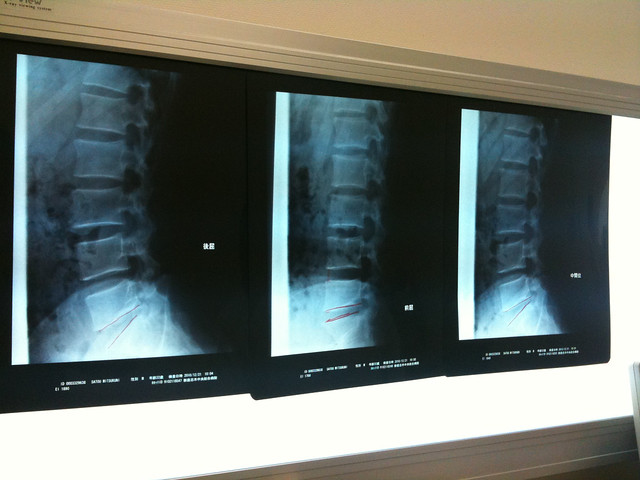 第五腰椎？の下？に椎間板ヘルニアの疑いあり、治療法としては痛み止めと安静とのこと。二週間経過して痛みが続くようならMRI撮りましょうとなりました。