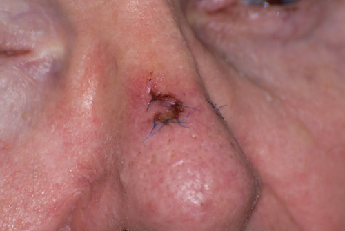 RaderBob Nose Stitches