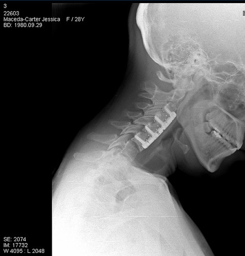 My Neck X-Ray