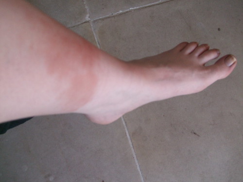 My poor swollen bruised ankle.  It's got worse since then too...EEKS!