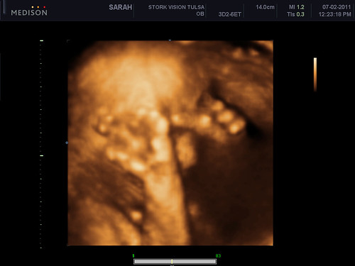Iris Adella - 3D Ultrasound