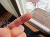 Post Finger Felon Surgery