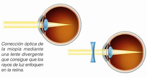 Corrección óptica de la miopía mediante una lente divergente que consigue que los rayos de luz enfoquen en la retina