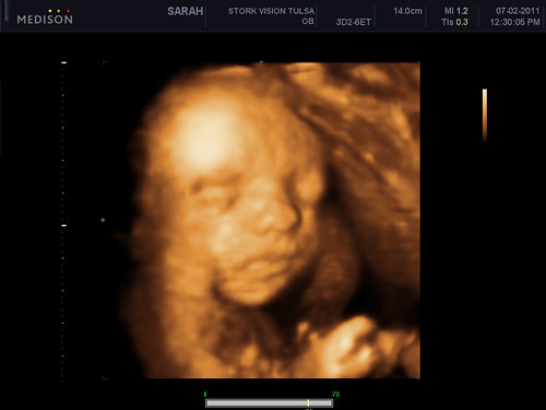 Iris Adella - 3D Ultrasound