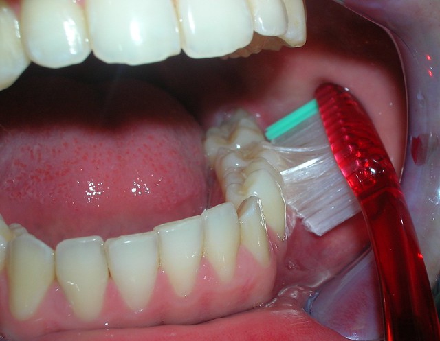 Zona molares inferiores vestibular