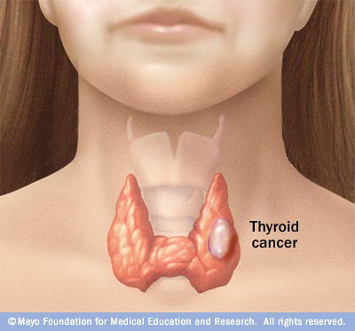 Thyroid Cancer Signs And Symptoms