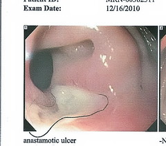 anastomotic ulcer KC 12-16-2010