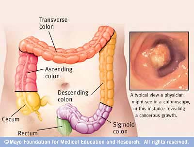  bowel cancer symptoms