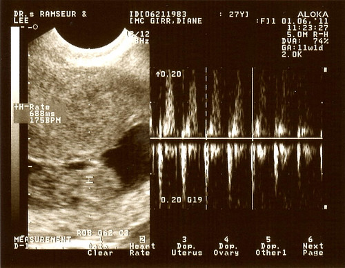 Ultrasound Heartrate 176