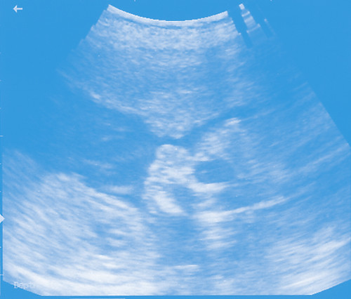 ultrasound a - 19 wks blue.jpg