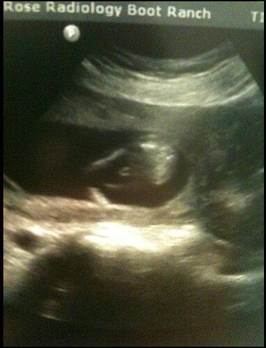 15 weeks ultrasound