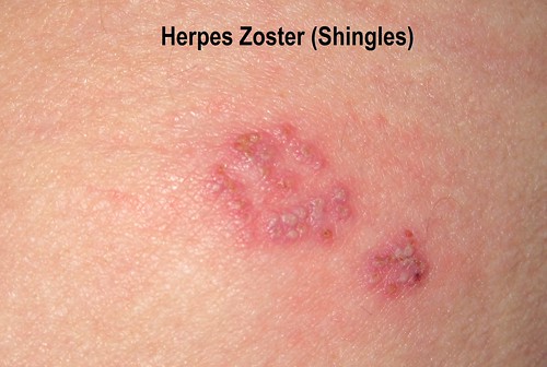 herpes zoster shingles. Herpes Zoster - Shingles