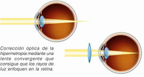 Corrección óptica de la hipermetropía mediante una lente convergente que consigue que los rayos de luz enfoquen en la retina