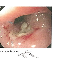 Anastamotic ulcer KC 12-16-2010
