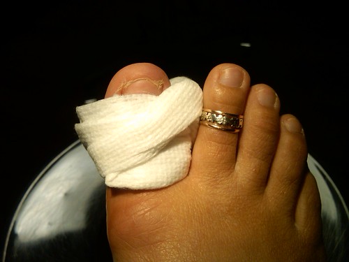 toe surgery