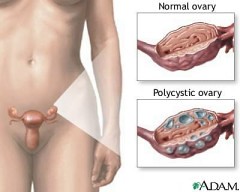 多囊性卵巢症候群2