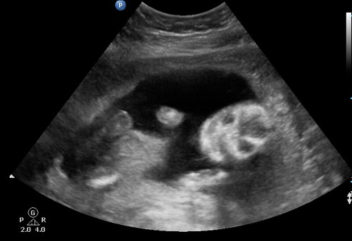 Jan. 31 Ultrasound