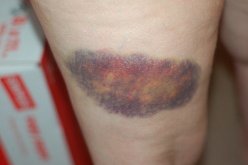 Kate's Leg Bruise