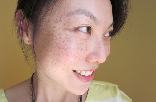 freckles3