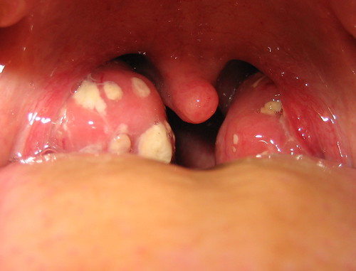 tonsillitis_2