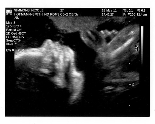 23 week ultrasound