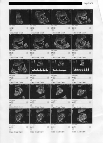 [13W+2D] 無敵兔初期妊娠評估報告