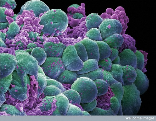 Breast cancer cells