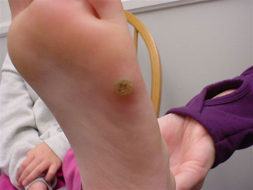 common warts on legs. While common warts appear on