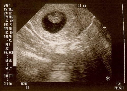 Ultrasound - 7 weeks 6 days