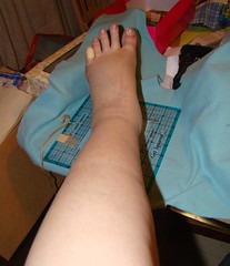 Left calf, ankle and foot- Allergy- water retention.