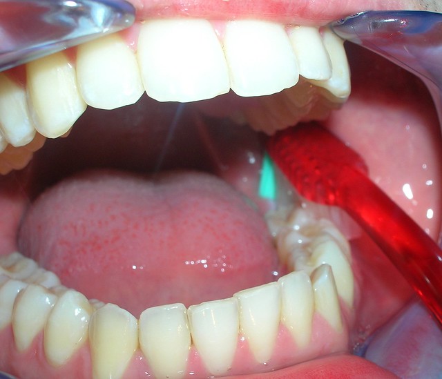 Zona 3º molar inferior