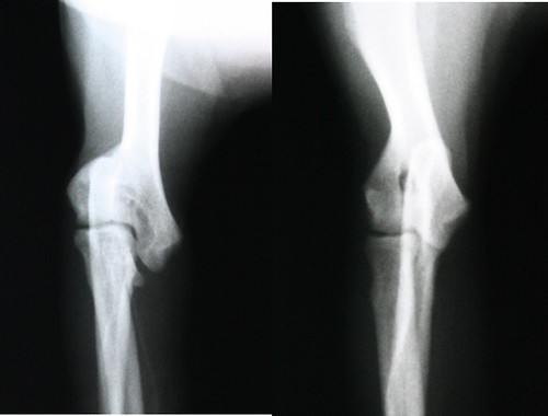 Humeral Malformation