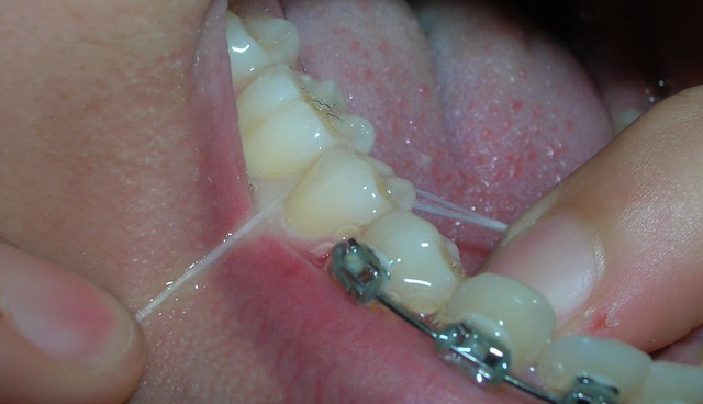Cinta dental molares inferiores