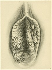 Anglų lietuvių žodynas. Žodis pruritus vulvae reiškia niežulys vulva lietuviškai.