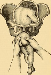 Image from page 658 of "A Reference handbook of the medical sciences : embracing the entire range of scientific and practical medicine and allied science" (1885)