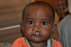 He will have the first stage of surgery, repairing the cleft lip • <a style="font-size:0.8em;" href="http://www.flickr.com/photos/109076046@N08/30041185862/" target="_blank">View on Flickr</a>